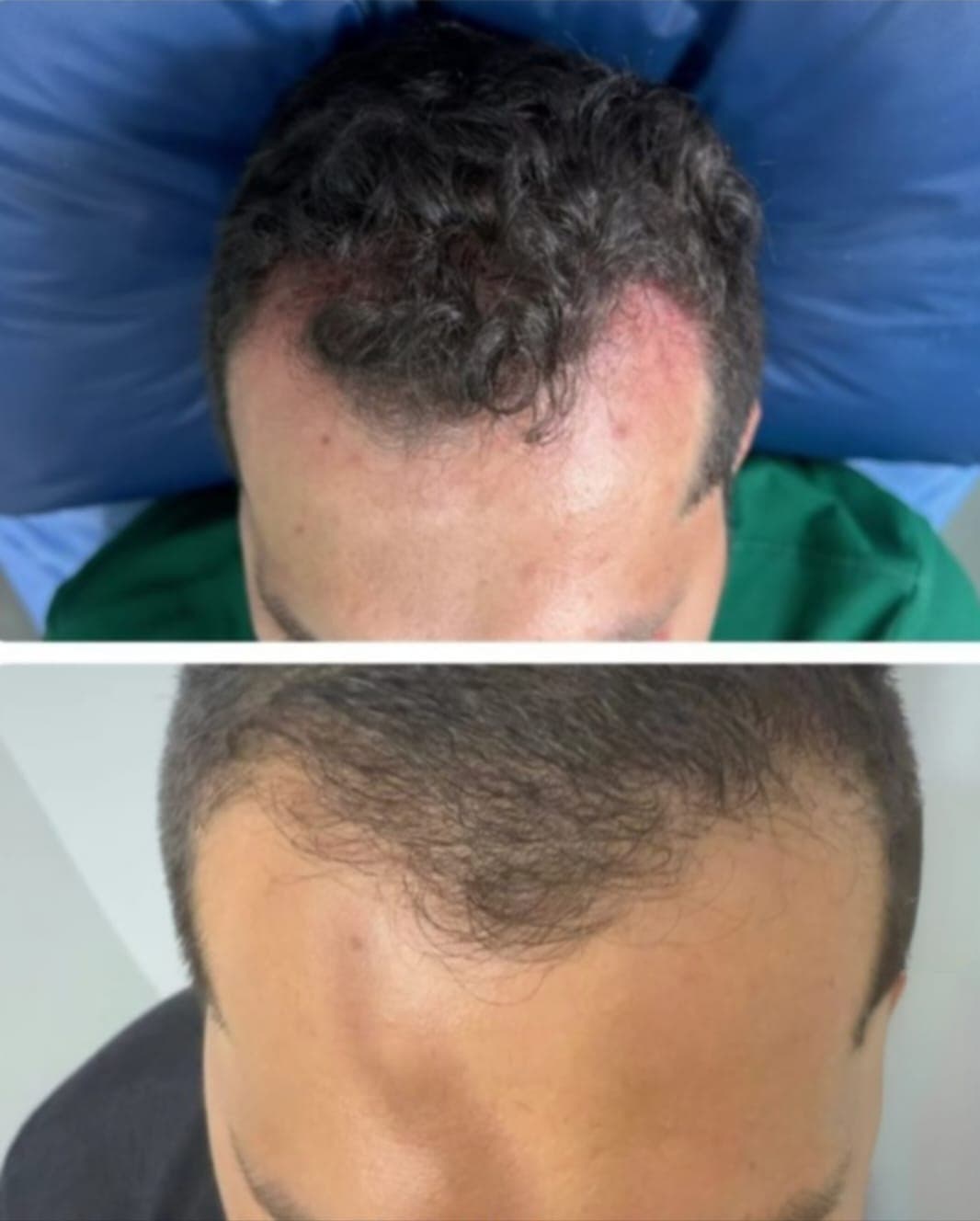 Atlantis Hair Before and After